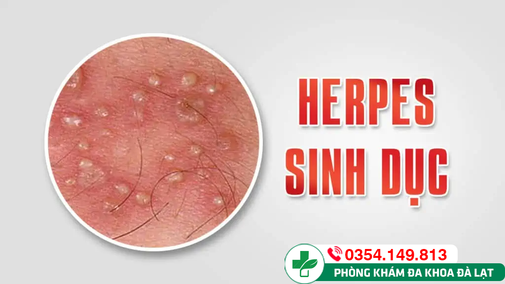 Nhận diện triệu chứng herpes ở dương vật nam giới 